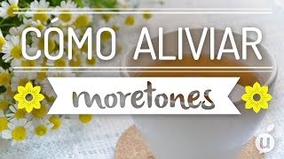 Cómo Aliviar Moretones Curar Moretones Cómo Reducir Moretones