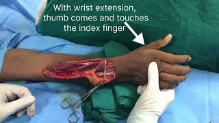 Considerations in Rerouting Extensor Pollicis Longus- Supplementary Video @WorldScientific