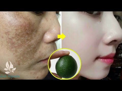 1 Quả Chanh - 5 Cách Trị Nám Tàn Nhang Hiệu Quả Nhất, Da Sần Sùi Đen Kịt Bỗng Hóa Trắng Mịn Nõn Nà