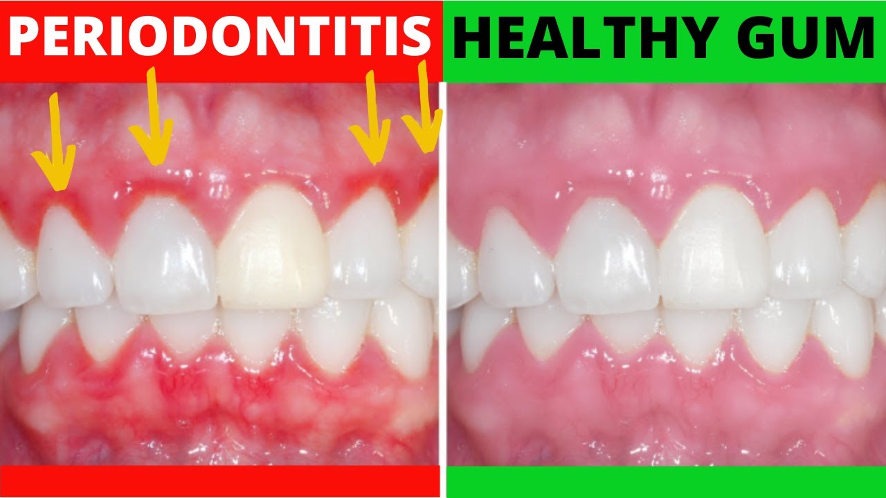 Periodontal Disease Definition For Dummies - How To Treat Gum Disease And  Periodontitis - YouTube