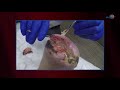 WCW: Removing Necrotic Tissue to Promote Healing