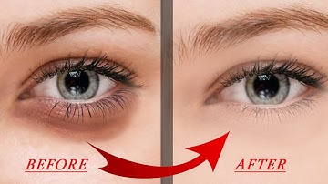 Remove Eyes Dark Circle In Photoshop #shorts