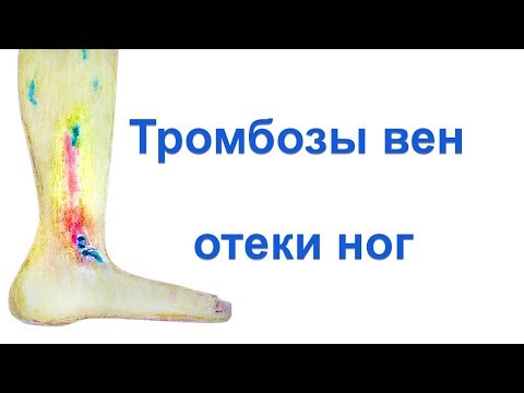 Тромбоз вен, отек ноги