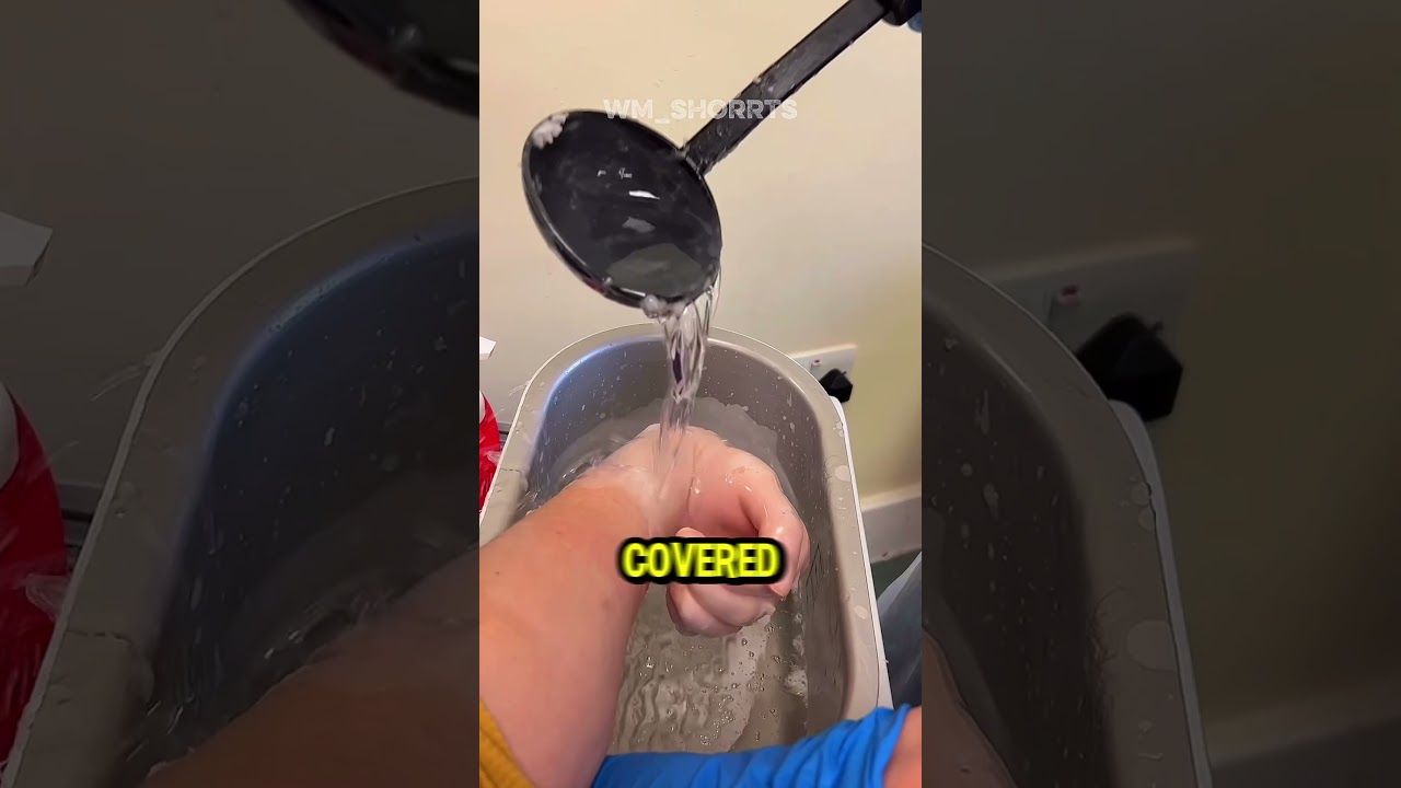 Paraffin Therapy Restores Hand Movement 