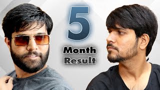 Before After BEARD Hair Transplant Results | Planning to 5 Months | Live By Dr. Vivek Galani.