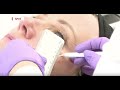 Profhilo | Xposé | The Laser and Skin Clinic
