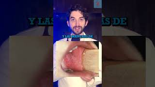 ALERTA Casos confirmados de Sarampion en Mexico medicina sarampion salud infecci