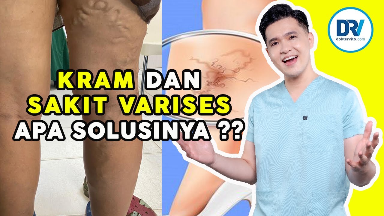 Dr Vito | Pengalaman Pasien Varises Tanpa Pembedahan. LASER atau LEM?