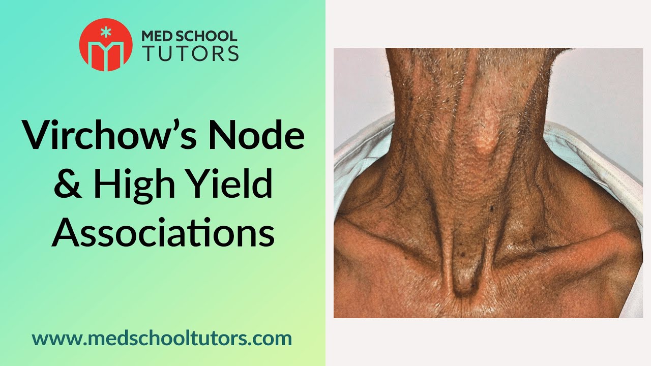 Virchow S Node And High Yield Associations For The Usmle Youtube