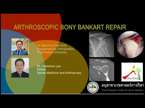 ShoulderDislocation:ArthroscopicBonyBankartRepairผ่าตัดส่องกล้องซ่อมข้อไหล่หลุดเบ้ากระดูกแตก