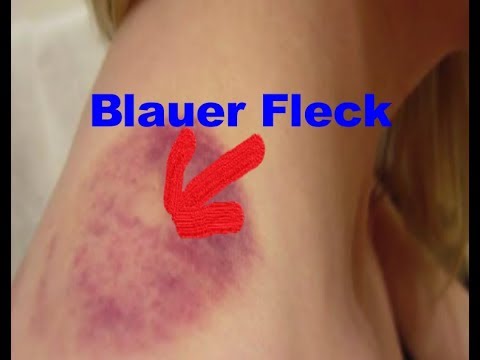 Video: Blaue Zehennägel: Ursachen, Behandlungen Und Wann Sie Einen Arzt Aufsuchen Sollten