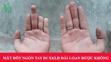 Mất đốt ngón tay có đi xklđ Đài Loan được không?|AVB quốc tế