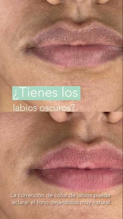 ¿Tienes los labios oscuros? ¿Deseas aclararlos? La técnica CCLIPS te puede ayudar a lograrlo