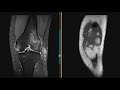 Normal acl and acl tear  first look mri