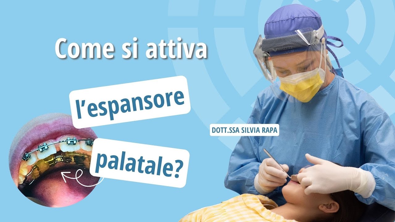 Componenti Apparecchio Denti 5 Viti Di Espansione Ortodontica