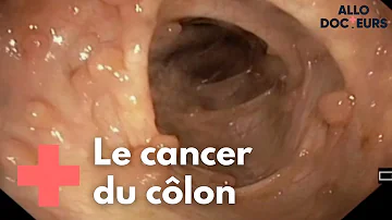 Quels sont les premiers symptômes du cancer de l'intestin ?