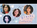 Braces in Your Twenties | Story Time | Vitasta Bhat