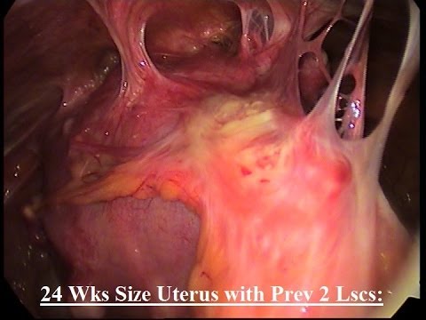 tlh 24 wks uterus with rt broad lig 10cm supra cervical fibroid