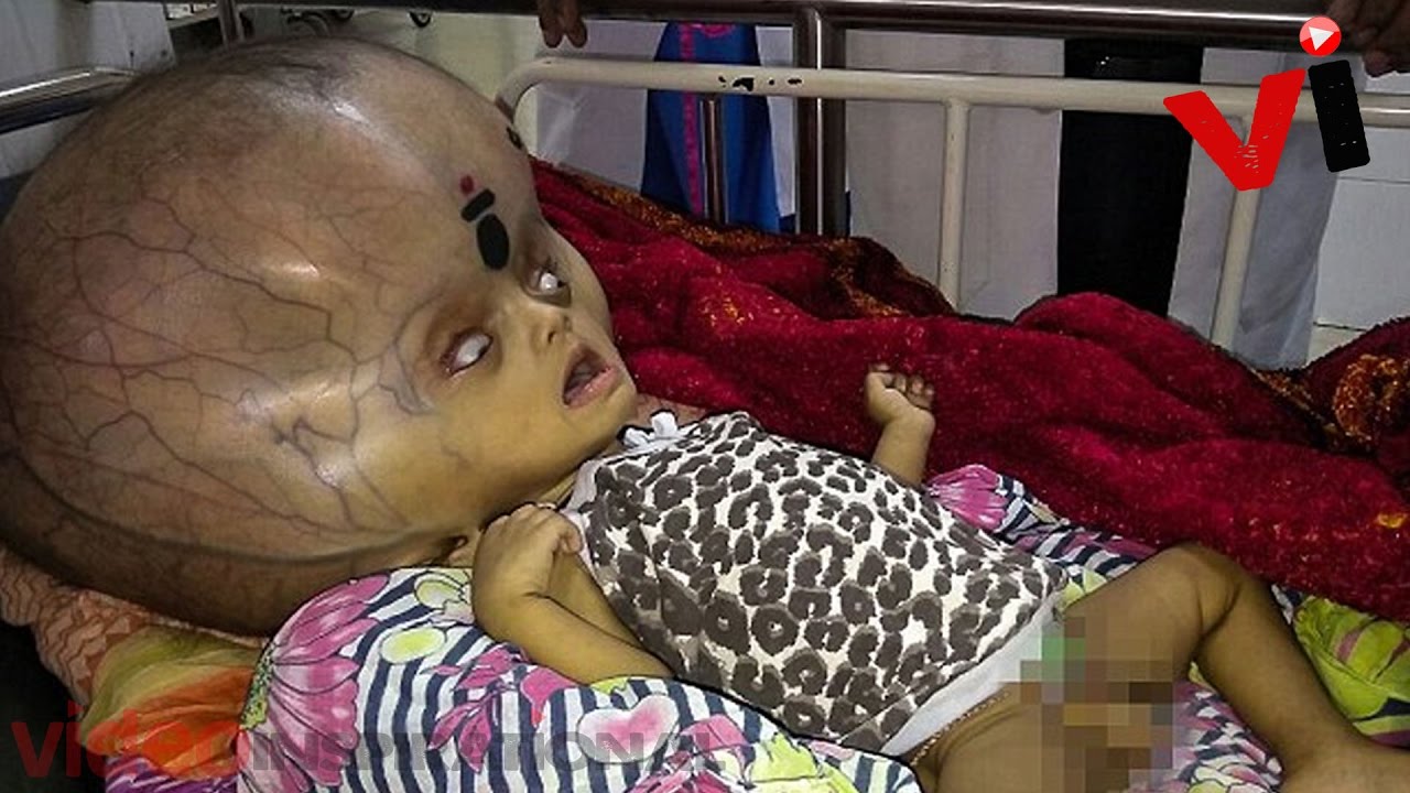 baby with world s largest head has life saving surgery to remove 8