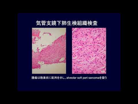 転移性肺腫瘍