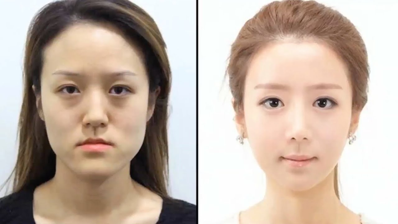 korean plastic surgery before after