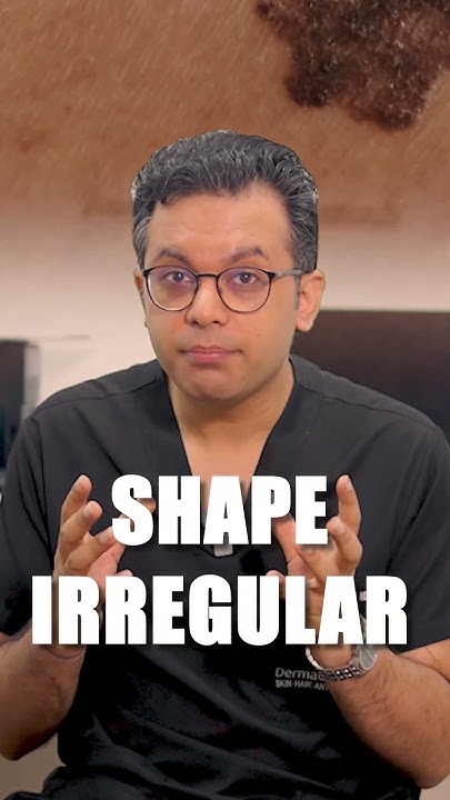Where Can I Watch The Mole Season 3 Can your mole be cancerous? | Dr Prateek Sondhi - YouTube