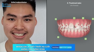 PHẦN MỀM CLINCHECK TRONG NIỀNG RĂNG INVISALIGN LÀ GÌ?