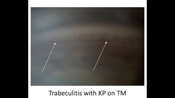 1 Slide in 5 Minutes: Glaucomatocyclitic Crisis (Malik Y. Kahook, MD)