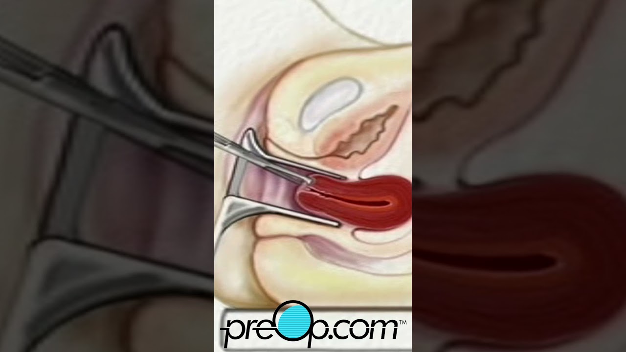 Dilation and Curettage D & C Surgery | PreOp&reg; Patient Engagement and Education #shorts