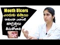 Mouth Ulcers ఎందుకు వస్తాయి రాకుండా ఎలాంటి జాగ్రత్తలు తీసుకోవాలి | Dr.Ruheena Khan Dental Tips | TDS