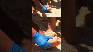 Dancer suffers tragic injury on Bondi Beach #shorts #bondirescue #injury #bondirescuelifeguards