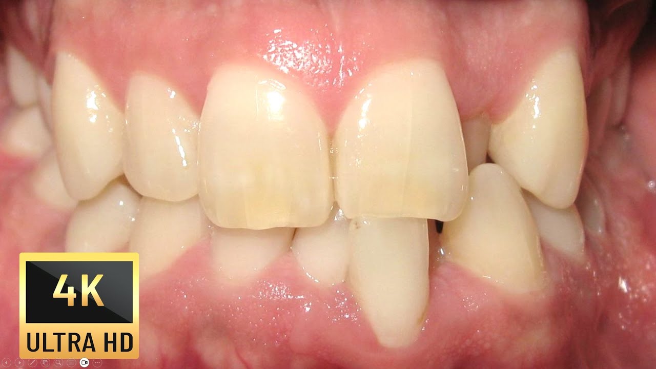 Тежко стеснение на челюстите при възрастен пациент!