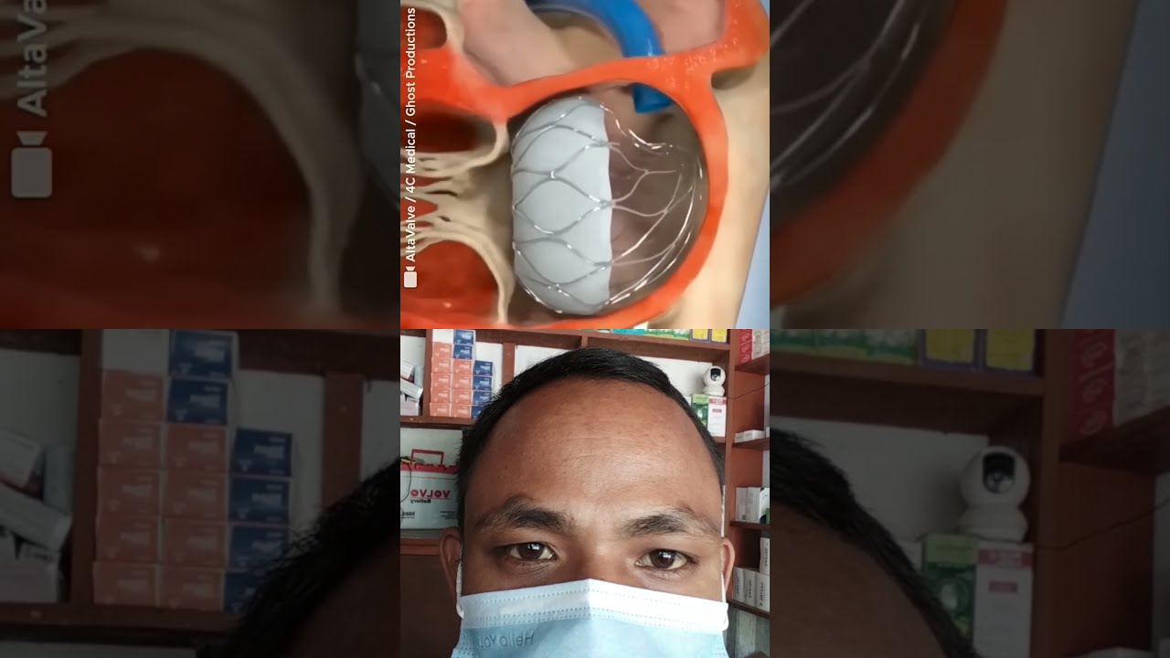 Altavalve Transcatheter Mitral Vale Replacement TMVR Shorts Medical Animation 3danimation