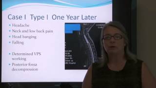 CSF presents "Consider Chiari: Chiari Malformation & Syringomyelia" - Gretchen Delametter, CPNP-AC