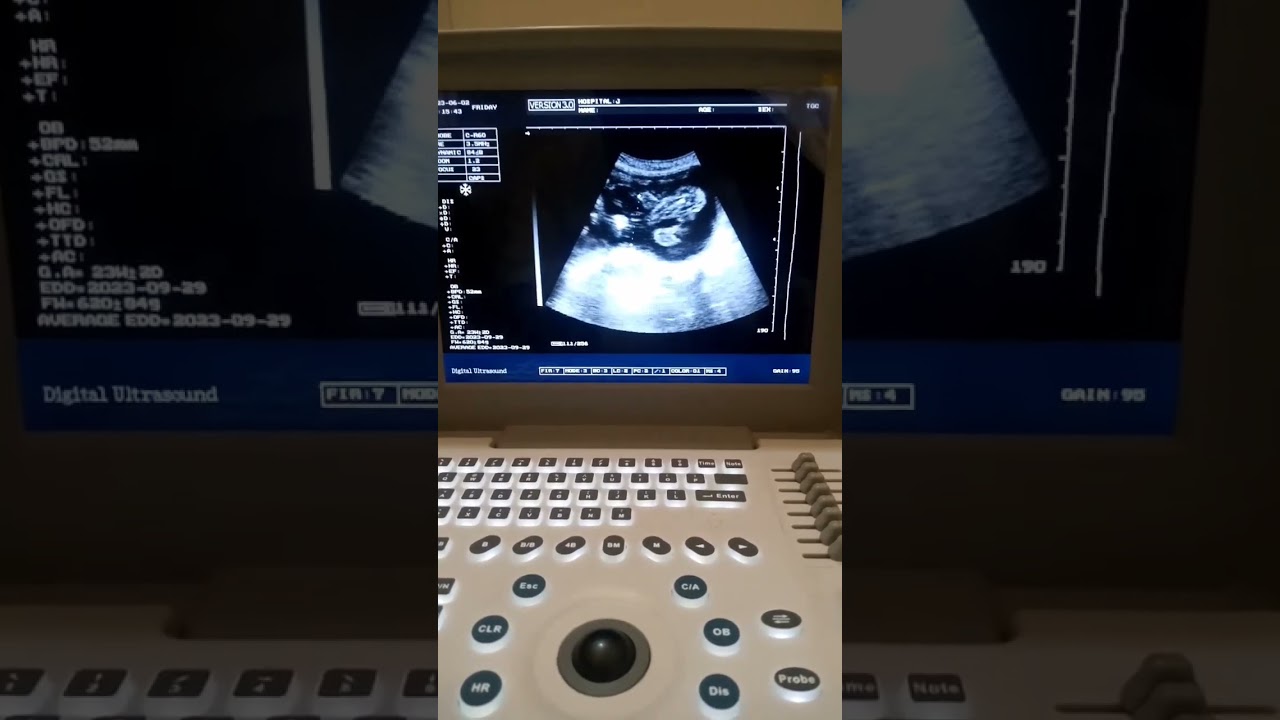 baby movement | ultrasound of FWB 