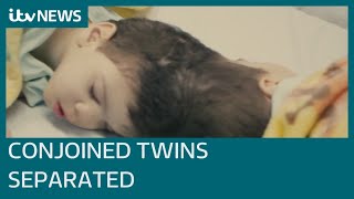 Conjoined twins with fused brains successfully separated with help of British surgeon | ITV News