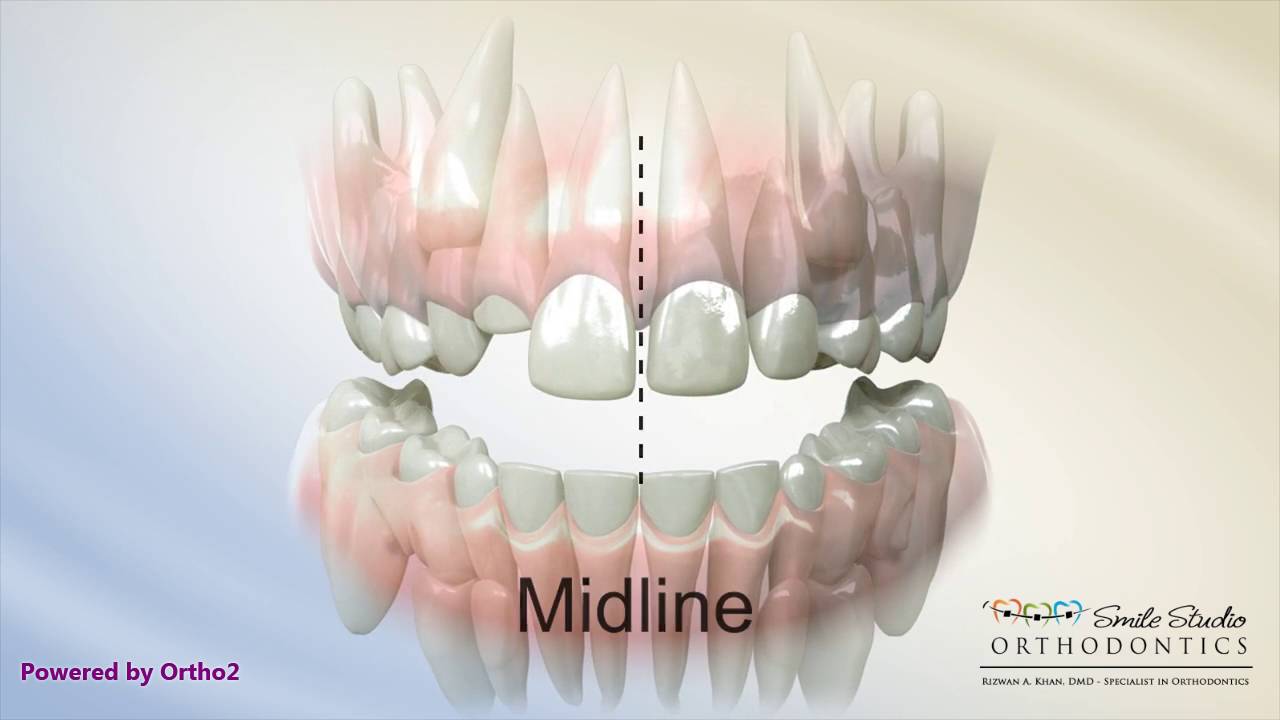 Midline Shift Due To Blocked Out Teeth Orthodontic Treatment YouTube 15-aktiviteter-f-r-f-rskolebarn-som-vill-korsa-mittlinjen-saayarelo