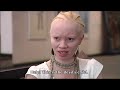 Leihlo la Sechaba: Albinism