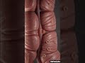 Diverticulitis Visualized