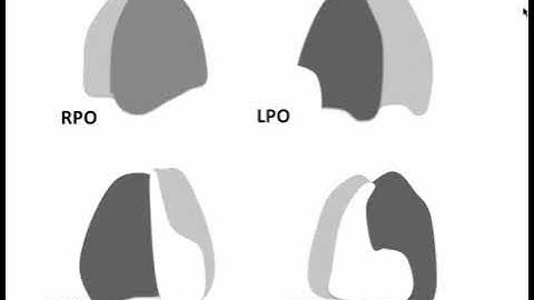 Nuclear medicine V/Q Scan for pulmonary embolism