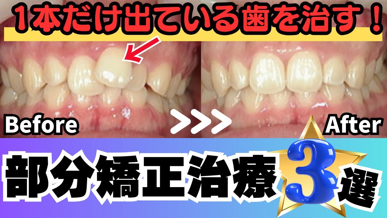 前歯 だけ 矯正