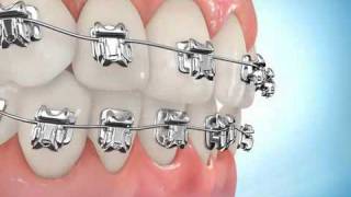 Klinika Ortholux - Aparat Fiks Damon