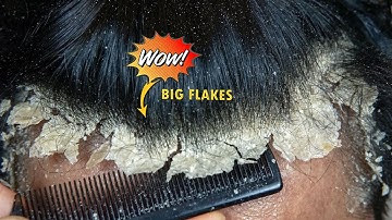 Itchy Dry Scalp Scratching Dandruff #1082