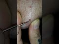 Trending giant needle removes ingrownchinhair