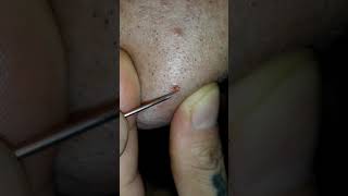  Giant Needle Removes 