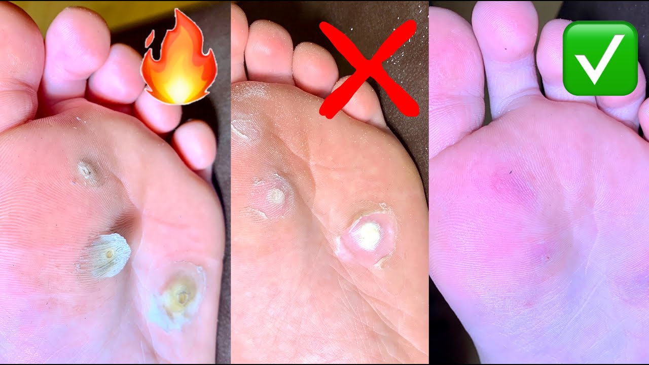 Боже мой!!! Удалить МОЗОЛЬ в домашних условиях - YouTube