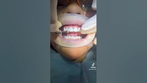 Composite Veneers offer SAVE BIG 💰💰💰