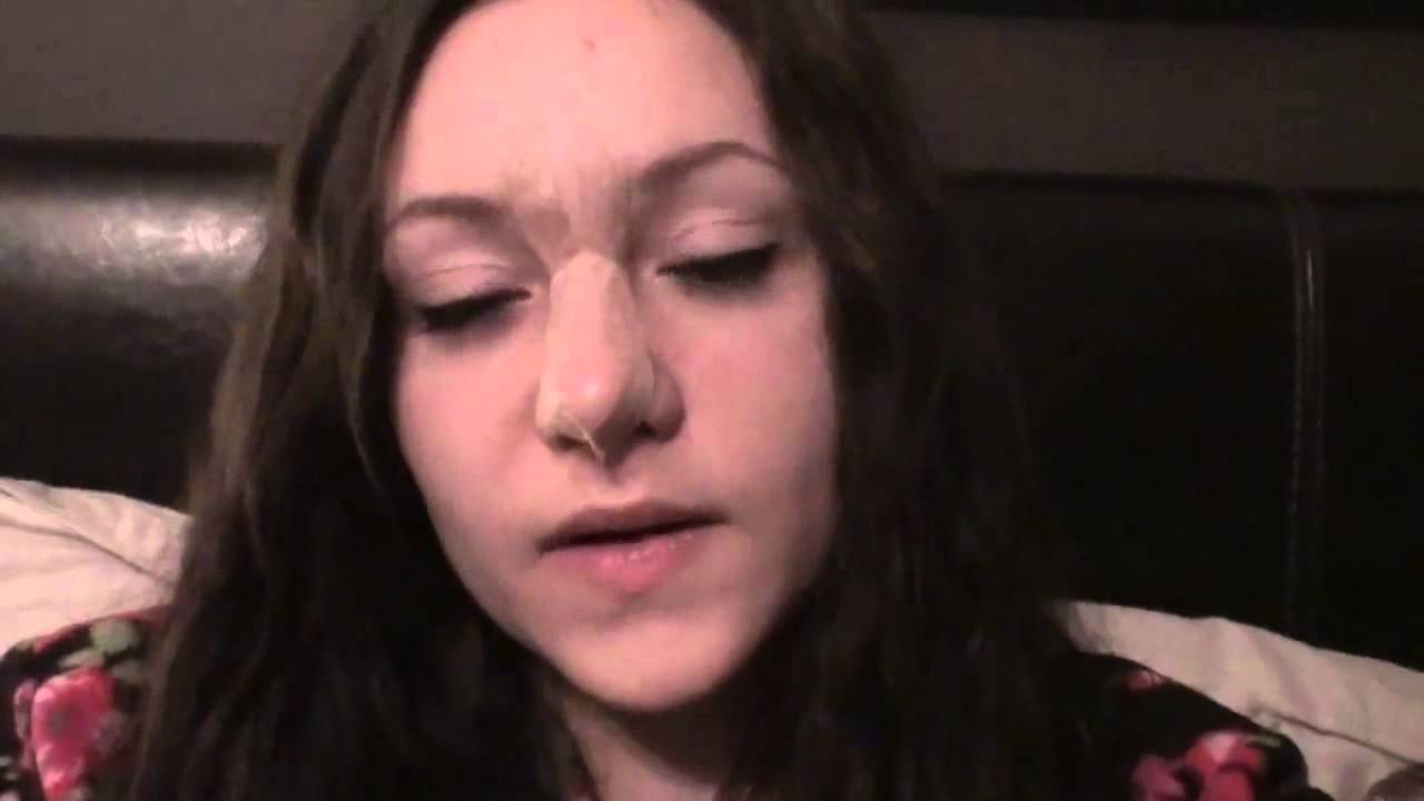 15 Rhinoplasty Nose Job Diary Day 14 After Surgery YouTube