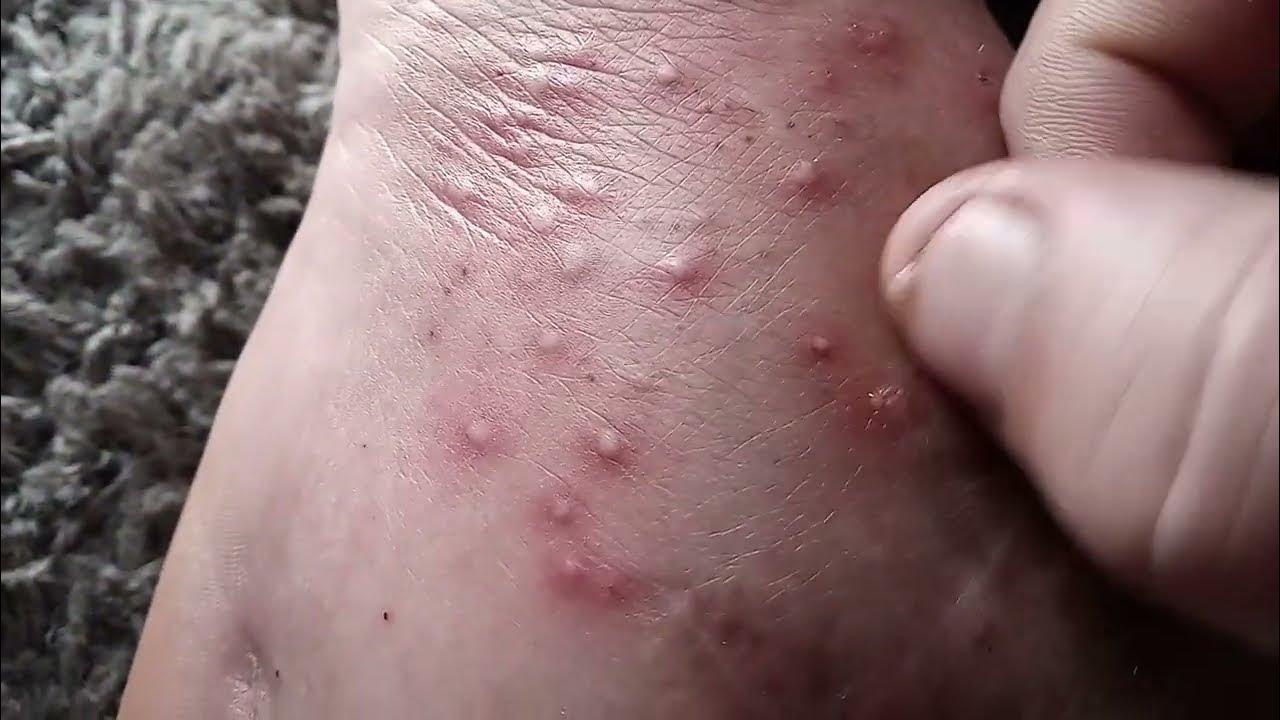 Awesome pimple popping video from over 300 ant bites youtube