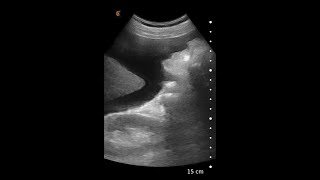 Ascites - Ultrasound Image Interpretation